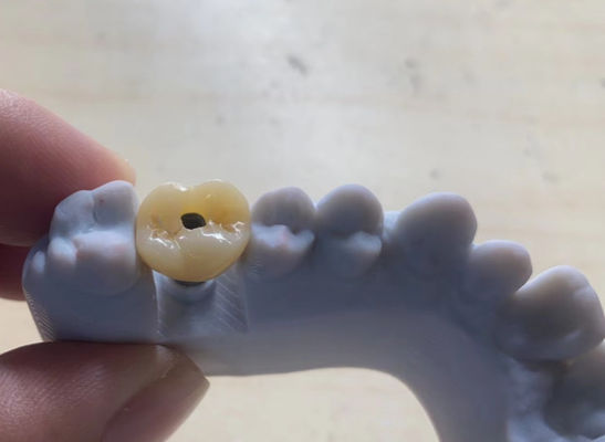 kaufen Hochpräzise Implantate mit unterstützender Krone Stabil und leicht zu warten Online-Herstellung