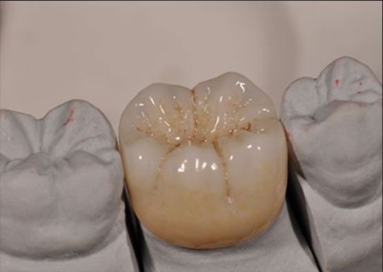 kaufen Höchste Ästhetik Noritake Zirkonia Natürliche Farbe Stabil für volle Zirkonia Krone Online-Herstellung