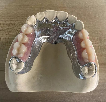 Hochfeste Gießmetall-Teilprothese Cocr Aolly mit 3D-Druck