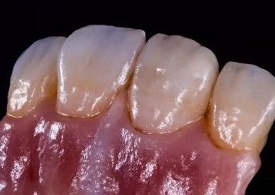 Deutsch Amanjilbach Zirkonia Zahnkrone Hohe Dichte mit Anpassung