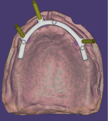 Personalisiertes CAD-CAM-Dentaldesign mit hoher Präzision für Implantatgestützte Stange
