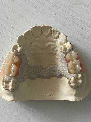 Spezialisierte Zahnpflege PEEK Acryl-Teilprothese mit sicherer Passform