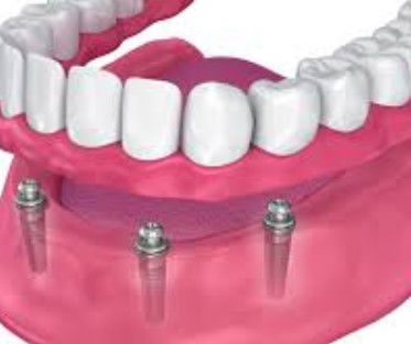 Anpassungsfähige Implantatkugel, langlebig für Implantatgehalten