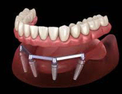 Sandblasted Zahnprothese Implantat Bar für durchsichtige und natürliche Ästhetik